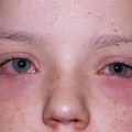 AnyConv.com__οφθαλμική αλλεργία
