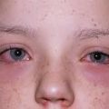 AnyConv.com__οφθαλμική αλλεργία